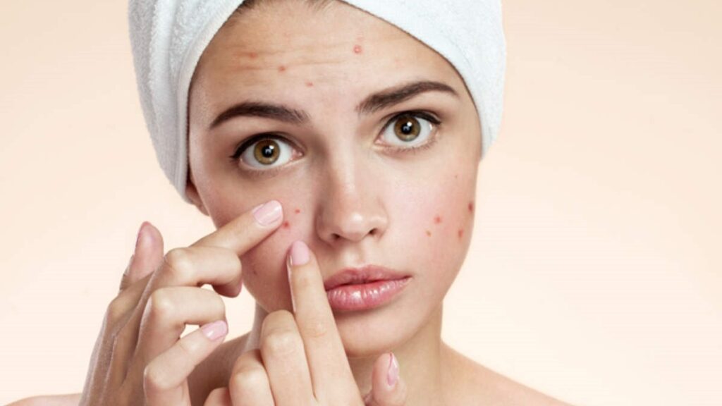 Acne and pimples and home remedies